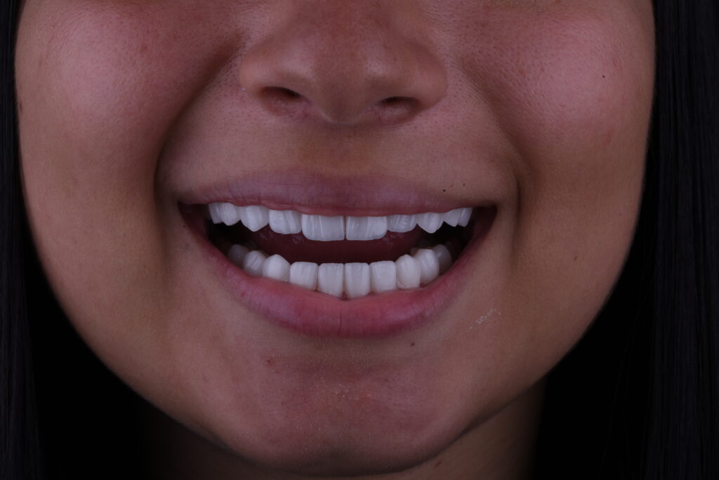 facettes dentaire prix